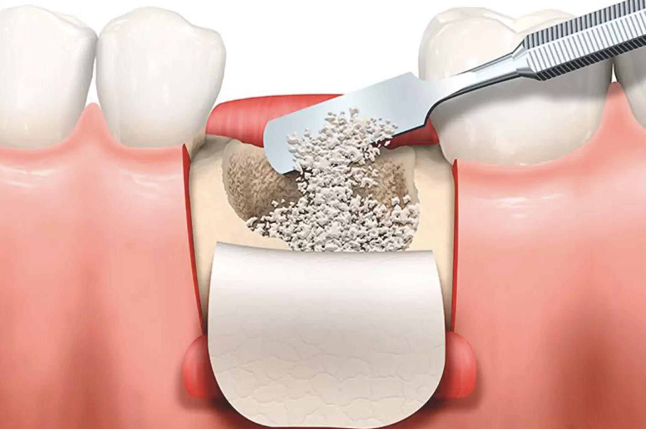 Regeneración Ósea Dental: Recuperando la Base Natural de su Sonrisa