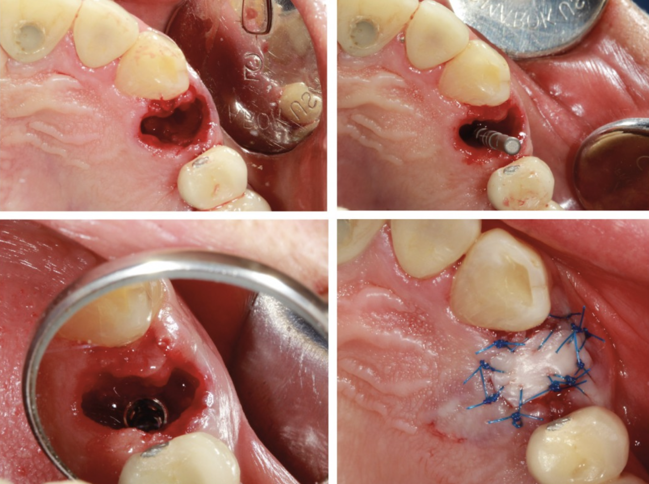 Rehabilitación sobre Implantes Dentales
