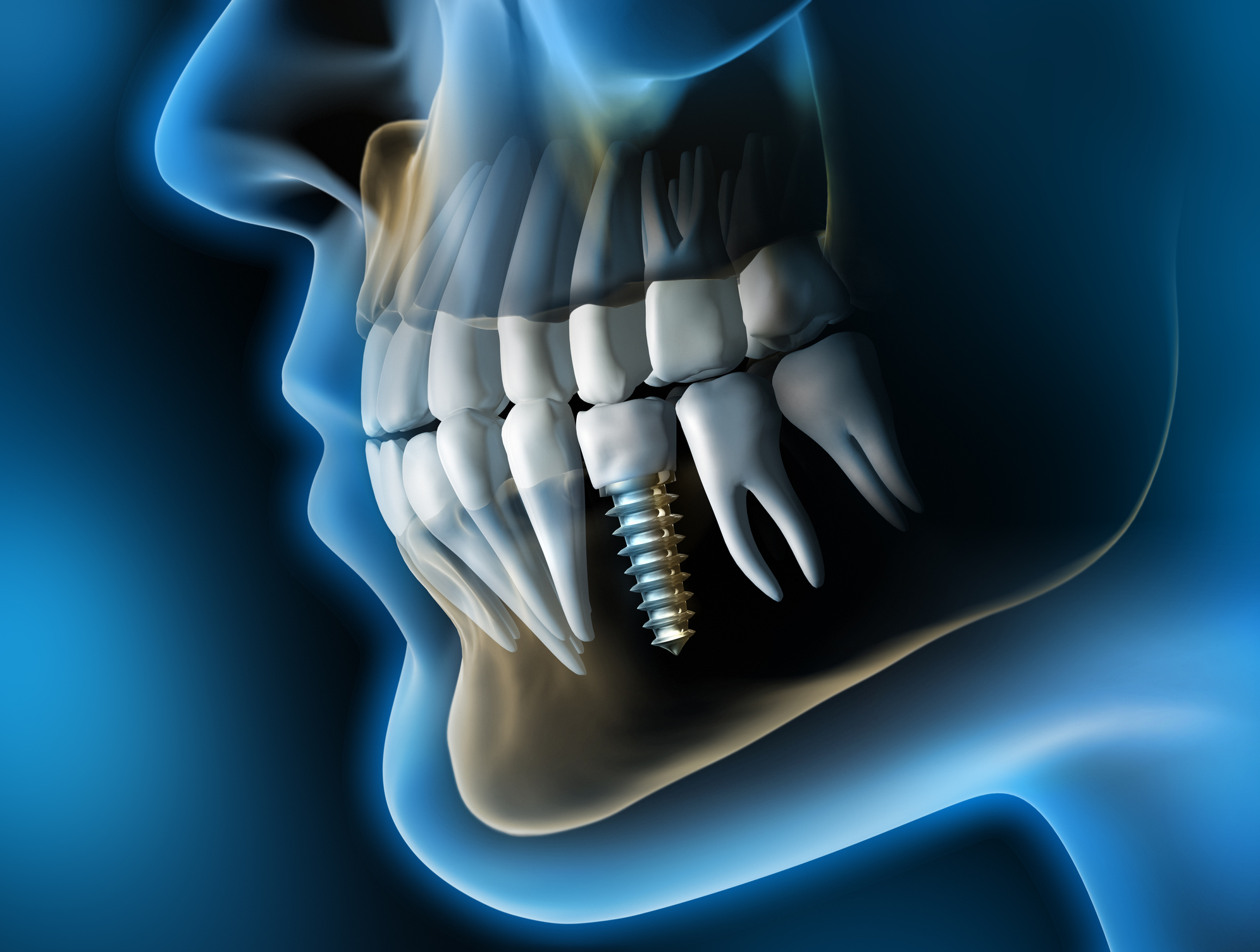 Implantes Dentales: La Solución Más Natural para Recuperar su Sonrisa
